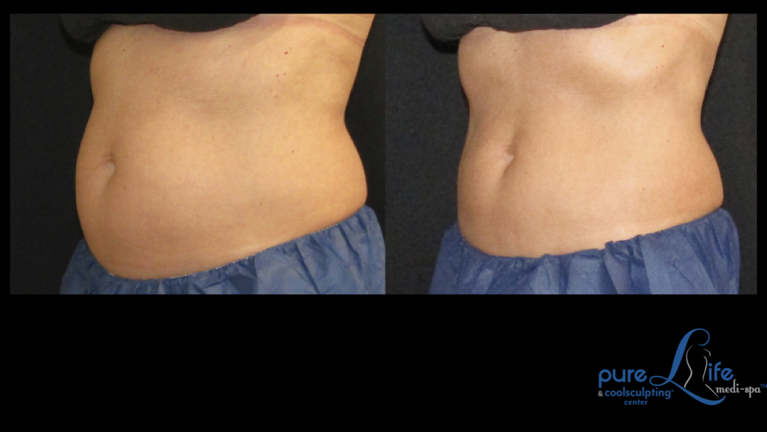 Coolsculpting Before and After Abs